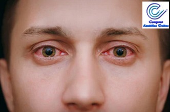 Las molestias con lentillas pueden causas ojo rojo y otras alteraciones en la vista